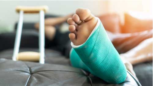 Person with broken leg, personal injury claims in Florida